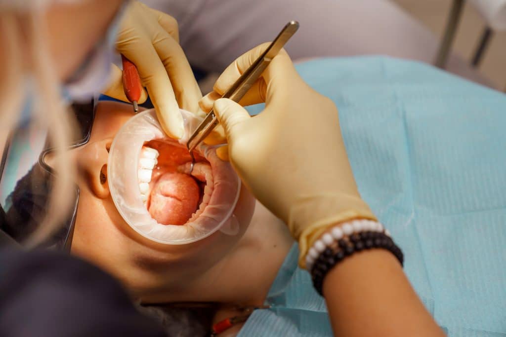 Tooth Extractions Kansas City